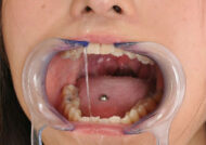 正しい開口器の使い方